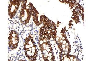 Immunohistochemistry analysis of paraffin-embedded human colon using CK-8 Polyclonal Antibody at dilution of 1:200. (KRT8 Antikörper)