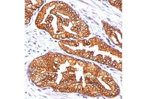 Formalin/paraffin human prostate carcinoma stained with ODC-1 antibody. (ODC1 Antikörper)