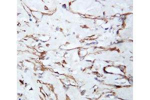 IHC-P: VEGF antibody testing of human lung cancer tissue (VEGFA Antikörper  (N-Term))