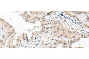 Immunohistochemistry of paraffin-embedded Human thyroid cancer tissue using GFI1B Polyclonal Antibody at dilution of 1:80(x200) (GFI1B Antikörper)