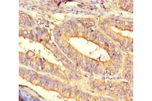 Immunohistochemistry of paraffin-embedded human endometrial cancer using ABIN7149400 at dilution of 1:100 (CNDP2 Antikörper  (AA 2-475))