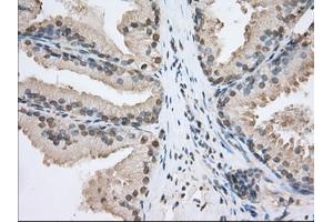 Immunohistochemical staining of paraffin-embedded Adenocarcinoma of Human ovary tissue using anti-SNX9 mouse monoclonal antibody. (SNX9 Antikörper)