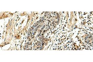 Immunohistochemistry of paraffin-embedded Human esophagus cancer tissue using NUTF2 Polyclonal Antibody at dilution of 1:110(x200) (NUTF2 Antikörper)