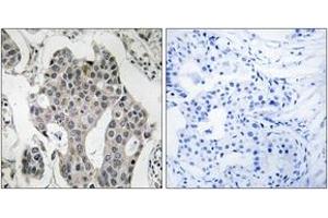 Immunohistochemistry analysis of paraffin-embedded human breast carcinoma tissue, using RAB3GAP2 Antibody. (RAB3GAP2 Antikörper  (AA 417-466))