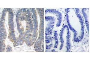 Immunohistochemical analysis of paraffin-embedded human colon carcinoma tissue using PKR (Ab-451) antibody (E021282). (EIF2AK2 Antikörper)