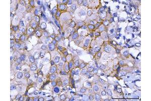 IHC analysis of HER2/ERBB2 using anti-HER2/ERBB2 antibody (ABIN7602717). (ErbB2/Her2 Antikörper  (AA 980-1230))