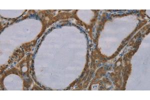 Immunohistochemistry of paraffin-embedded Human thyroid cancer tissue using S100A6 Polyclonal Antibody at dilution 1:35 (S100A6 Antikörper)