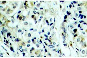 Immunohistochemistry of paraffin-embedded Human breast carcinoma using Phospho-HDAC5(S498) Polyclonal Antibody (HDAC5 Antikörper  (pSer498))