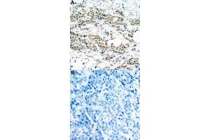 Immunohistochemical staining of human breast cancer tissue by FOXO4 (phospho S197) polyclonal antibody  without blocking peptide (A) or preincubated with blocking peptide (B) under 1:50-1:100 dilution. (FOXO4 Antikörper  (pSer197))