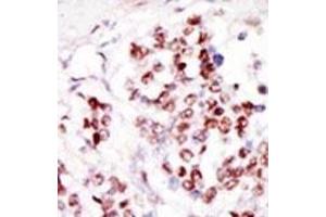 Formalin-fixed and paraffin-embedded human cancer tissue reacted with the primary antibody, which was peroxidase-conjugated to the secondary antibody, followed by DAB staining. (TLK1 Antikörper  (C-Term))