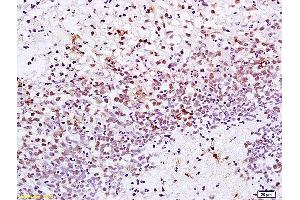 Formalin-fixed and paraffin embedded human gastric carcinoma labeled with Anti-XRCC1 Polyclonal Antibody, Unconjugated (ABIN673539) at 1:200 followed by conjugation to the secondary antibody and DAB staining. (XRCC1 Antikörper  (AA 1-120))