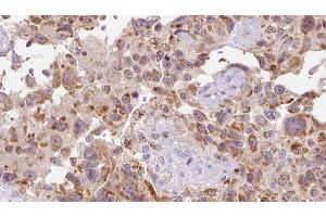 ABIN6273118 at 1/100 staining Human Melanoma tissue by IHC-P. (FSTL1 Antikörper  (N-Term))