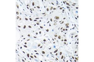 Immunohistochemistry of paraffin-embedded human esophageal cancer using SNRP Rabbit pAb (2161) at dilution of 1:200 (40x lens). (SNRPA1 Antikörper  (AA 1-220))