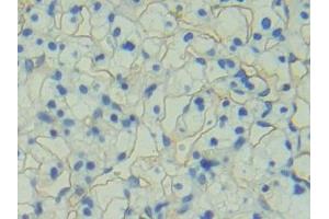 Detection of PODXL in Human Renal cancer Tissue using Polyclonal Antibody to Podocalyxin (PODXL)