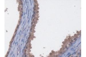 Detection of EEF2 in Human Prostate Tissue using Polyclonal Antibody to Eukaryotic Translation Elongation Factor 2 (EEF2) (EEF2 Antikörper  (AA 32-233))
