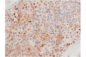 ABIN6267525 at 1/200 staining Human liver cancer tissue sections by IHC-P.