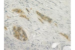 ABIN6266372 and ABIN6277338 at 1/100 staining human pancreatic carcinoma by IHC-P. (CDH23 Antikörper  (N-Term))