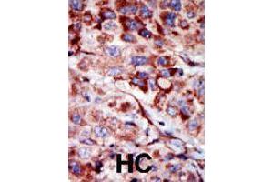 Formalin-fixed and paraffin-embedded human hepatocellular carcinoma tissue reacted with AK2 polyclonal antibody  , which was peroxidase-conjugated to the secondary antibody, followed by AEC staining. (Adenylate Kinase 2 Antikörper  (C-Term))