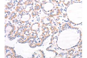 The image on the left is immunohistochemistry of paraffin-embedded Human thyroid cancer tissue using ABIN7131495(TRPC7 Antibody) at dilution 1/25, on the right is treated with fusion protein. (TRPC7 Antikörper)