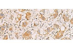 Immunohistochemistry of paraffin-embedded Human liver cancer tissue using RAB38 Polyclonal Antibody at dilution of 1:60(x200) (RAB38 Antikörper)
