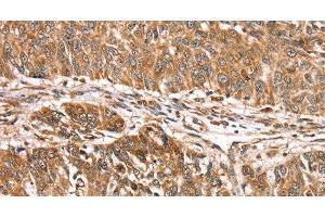 Immunohistochemistry of paraffin-embedded Human lung cancer using PDLIM4 Polyclonal Antibody at dilution of 1:30 (PDLIM4 Antikörper)