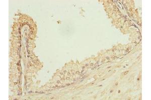 Immunohistochemistry of paraffin-embedded human prostate cancer using ABIN7163733 at dilution of 1:100 (POGZ Antikörper  (AA 1-300))