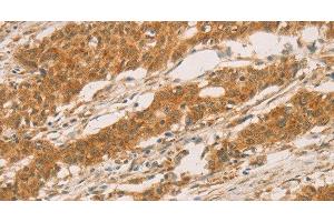 Immunohistochemistry of paraffin-embedded Human gastric cancer tissue using SLC6A3 Polyclonal Antibody at dilution 1:50 (SLC6A3 Antikörper)