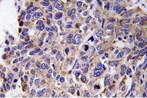 Immunohistochemistry (IHC) analyzes of MMP-12 antibody in paraffin-embedded human lung carcinoma tissue. (MMP12 Antikörper)