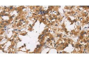 Immunohistochemistry of paraffin-embedded Human thyroid cancer tissue using DUSP23 Polyclonal Antibody at dilution 1:30 (DUSP23 Antikörper)