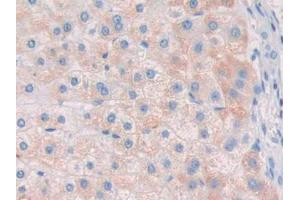 IHC-P analysis of Human Liver cancer Tissue, with DAB staining. (Ribonuclease A8 Antikörper  (AA 19-154))