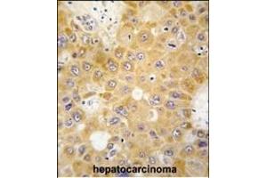 Formalin-fixed and paraffin-embedded human hepatocarcinoma tissue reacted with H1 antibody (N-term) 6302a , which was peroxidase-conjugated to the secondary antibody, followed by DAB staining. (APH1A Antikörper  (N-Term))