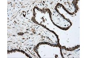 Immunohistochemical staining of paraffin-embedded Carcinoma of prostate tissue using anti-PRKAR2A mouse monoclonal antibody. (PRKAR2A Antikörper)