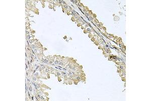 Immunohistochemistry of paraffin-embedded human prostate using CDH5 antibody at dilution of 1:100 (x40 lens). (Cadherin 5 Antikörper)