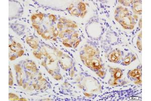 Formalin-fixed and paraffin embedded human gastric carcinoma labeled with Anti YES1 Polyclonal Antibody, Unconjugated (ABIN754798) at 1:200 followed by conjugation to the secondary antibody and DAB staining (YES1 Antikörper  (AA 441-541))