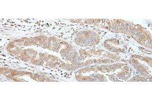 Immunohistochemistry of paraffin-embedded Human liver cancer tissue using USO1 Polyclonal Antibody at dilution of 1:30(x200) (USO1 Antikörper)
