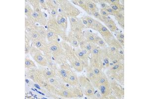 Immunohistochemistry of paraffin-embedded human liver cancer using PON1 antibody (ABIN5975112) at dilution of 1/100 (40x lens). (PON1 Antikörper)