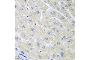 Immunohistochemistry of paraffin-embedded human liver cancer using PON1 antibody (ABIN5975112) at dilution of 1/100 (40x lens). (PON1 Antikörper)