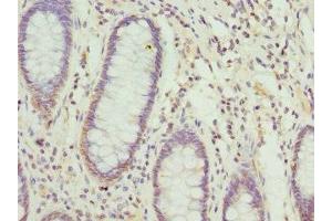 Immunohistochemistry of paraffin-embedded human colon cancer using ABIN7149015 at dilution of 1:100 (NFS1 Antikörper  (AA 208-457))