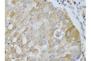 Immunohistochemistry of paraffin-embedded human breast cancer using HDAC8 antibody (ABIN5973443) at dilution of 1/100 (40x lens). (HDAC8 Antikörper)