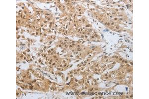 Immunohistochemistry of Human lung cancer using DNAJC7 Polyclonal Antibody at dilution of 1:25 (DNAJC7 Antikörper)