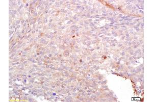Formalin-fixed and paraffin embedded human lung carcinoma labeled with Anti-Lck/p56-LCK Polyclonal Antibody, Unconjugated (ABIN748553) at 1:200 followed by conjugation to the secondary antibody and DAB staining.