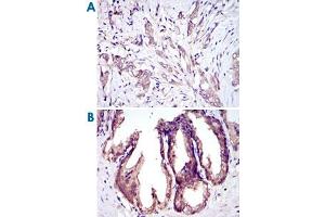Immunohistochemical analysis of paraffin-embedded human breast cancer tissues (A) and prostate tissues (B) using MAP3K5 monoclonal antibody, clone 2E4  with DAB staining.
