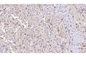 ABIN6273312 at 1/100 staining Human thyroid cancer tissue by IHC-P. (RPS14 Antikörper  (Internal Region))