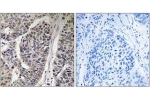 Immunohistochemistry analysis of paraffin-embedded human breast carcinoma, using p130 Cas (Phospho-Tyr410) Antibody. (BCAR1 Antikörper  (pTyr410))