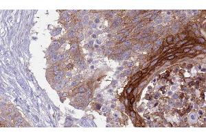 ABIN6277039 at 1/100 staining Human urothelial cancer tissue by IHC-P. (SLAMF1 Antikörper  (C-Term))