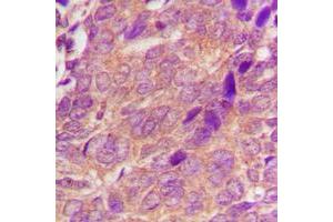 Immunohistochemical analysis of CDC25A staining in human breast cancer formalin fixed paraffin embedded tissue section.