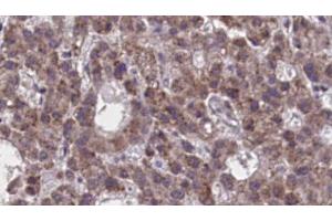 ABIN6273894 at 1/100 staining Human liver cancer tissue by IHC-P.