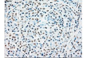 Immunohistochemical staining of paraffin-embedded Adenocarcinoma of colon tissue using anti-STK3mouse monoclonal antibody. (STK3 Antikörper)