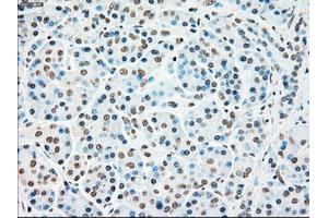 Immunohistochemical staining of paraffin-embedded Adenocarcinoma of colon tissue using anti-STK3mouse monoclonal antibody.