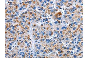 The image on the left is immunohistochemistry of paraffin-embedded Human liver cancer tissue using ABIN7128906(CENPJ Antibody) at dilution 1/40, on the right is treated with fusion protein. (CENPJ Antikörper)